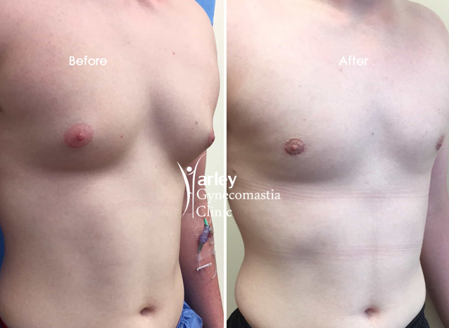 Male Chest Reduction - 001TPC-Side - The Private Clinic of Harley