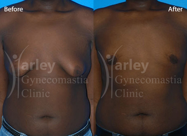 Male Chest Reduction - 001TPC-Side - The Private Clinic of Harley